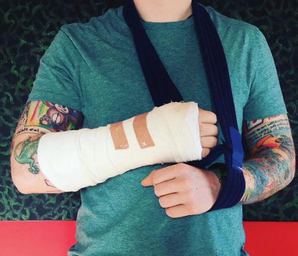 Ed Sheeran Broken Arm